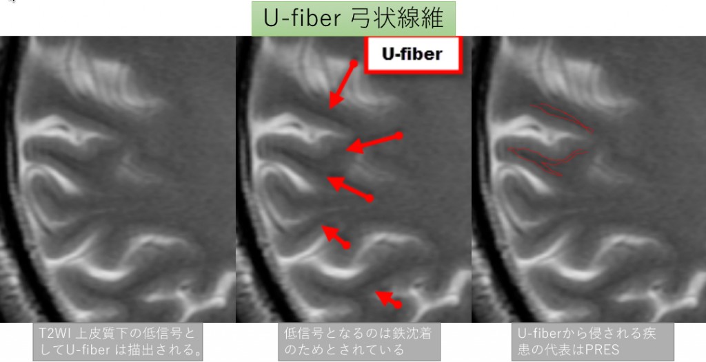 U-fiber の図