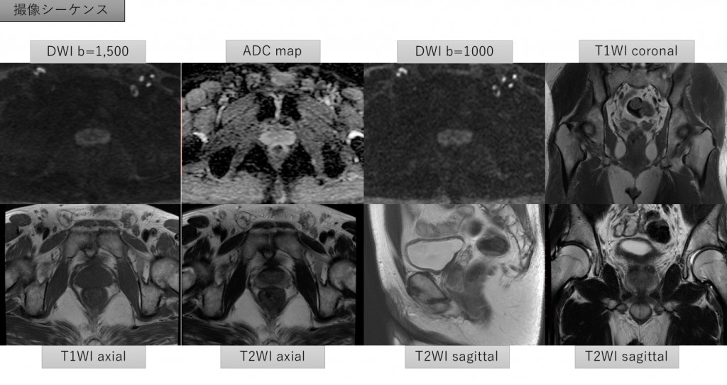PI-RADS当院シーケンス1