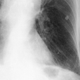 今回の胸部単純写真左下肺野