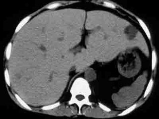 肝mri 糖源病