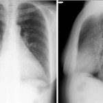 20140217 up HP case lung Chest radiograph