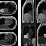 20140217 up HP case lung MRI