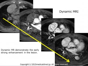Type A thymoma 62M MRI 4