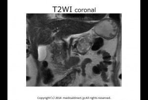 T2WI coronal 1