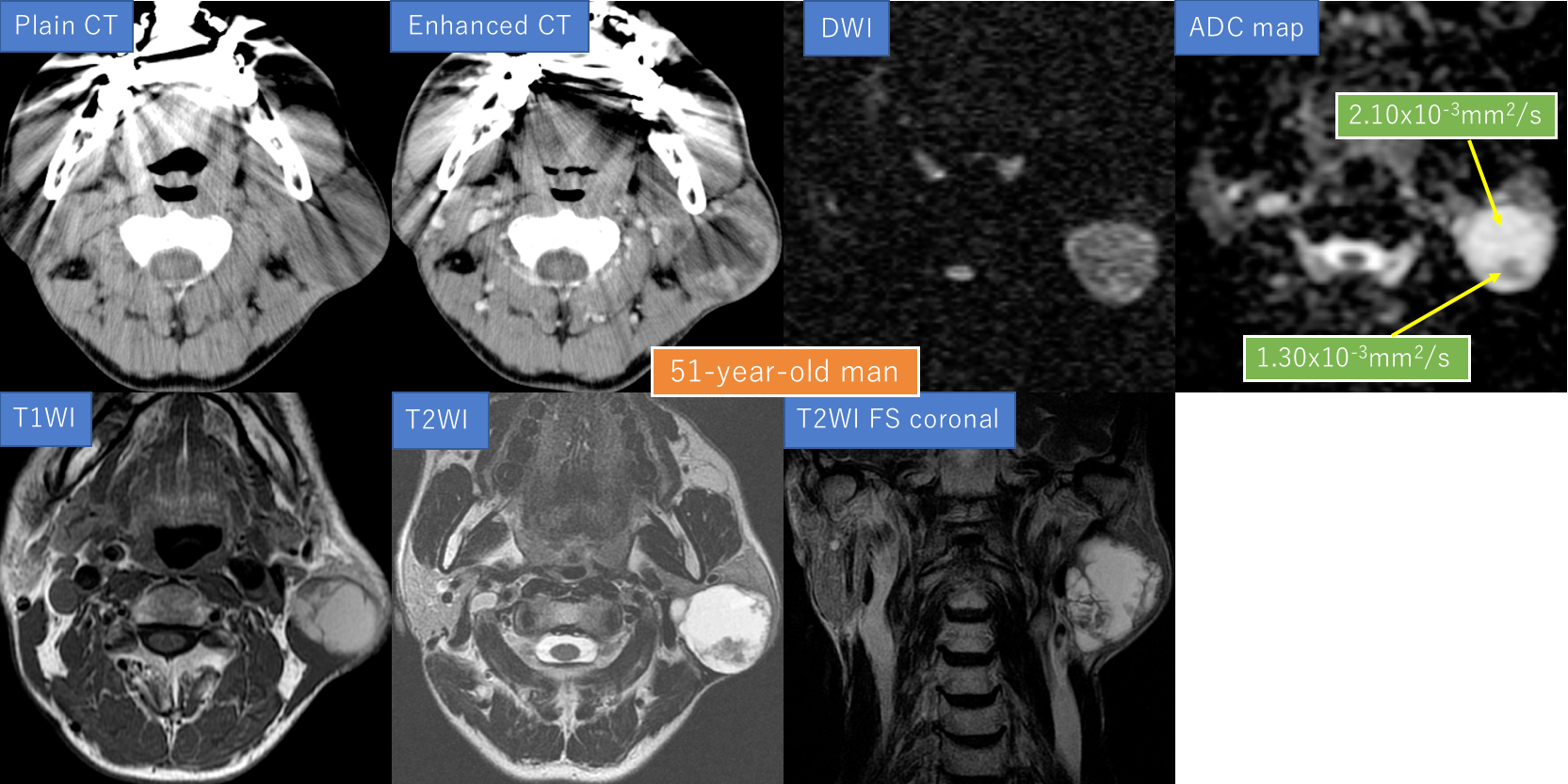 51-year-old man with left parotid gland tumor1