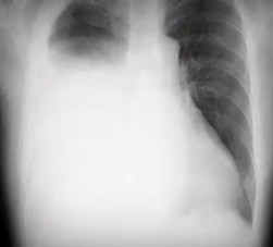 Lung9サムネ