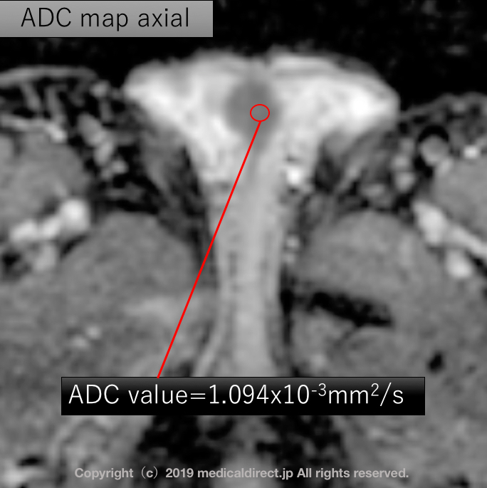 ADC map 測定